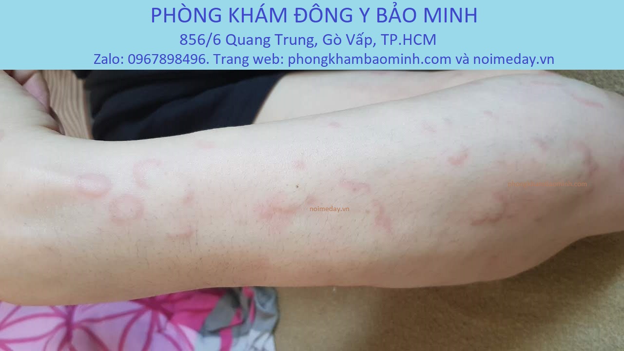 Nổi mề đay ngứa